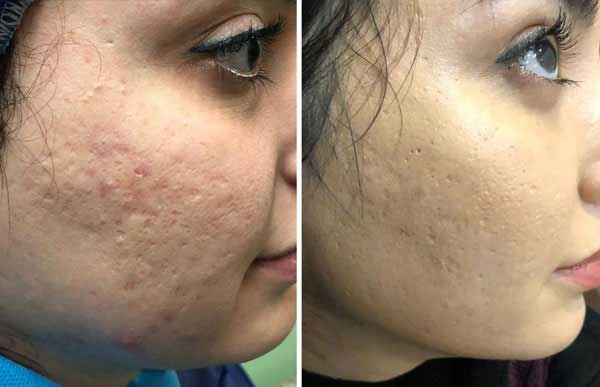 بهبود فرورفتگی و جای جوش صورت با تزریق چربی نوراریژن