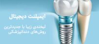 ایمپلنت دیجیتال در بابل و مازندران؛ لبخندی زیبا با جدیدترین روش‌های دندانپزشکی