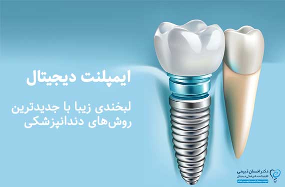 ایمپلنت دیجیتال در بابل و مازندران؛ لبخندی زیبا با جدیدترین روش‌های دندانپزشکی