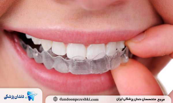 ارتودنسی نامرئی