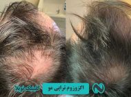 اگزوزوم تراپی مو چیست و چگونه باعث رشد مجدد مو ها می‌ شود ؟
