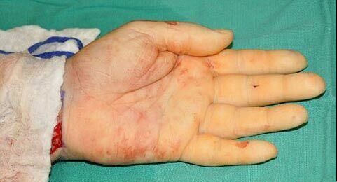 پیوند 2 دست یک جنازه به یک انسان زنده + عکس