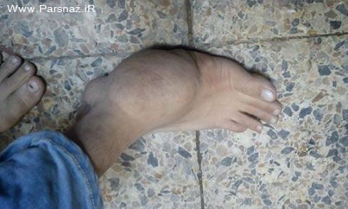 بیماری بسیار وحشتناک دختر جوان ایرانی + عکس