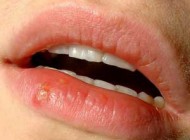 اطلاعات مفید و خواندنی درباره تبخال