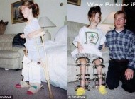 تلاش دردناک یک خانم کوتوله برای افزایش قد!! (عکس)
