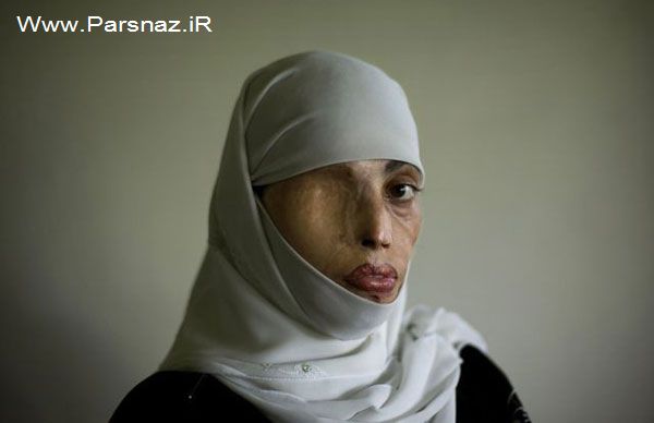 عکس های غم انگیز از زنان قربانی اسید پاشی (18+)