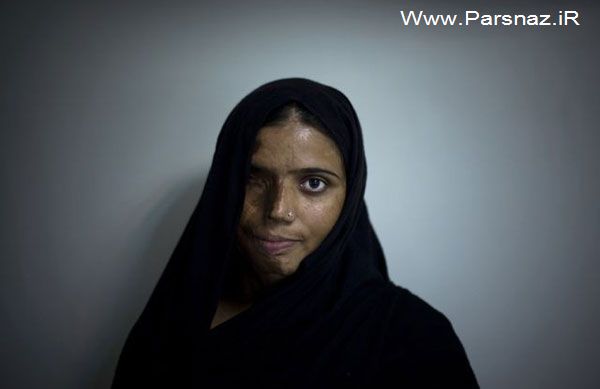 عکس های غم انگیز از زنان قربانی اسید پاشی (18+)