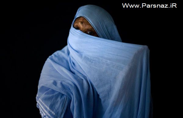 عکس های غم انگیز از زنان قربانی اسید پاشی (18+)