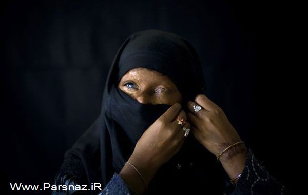 عکس های غم انگیز از زنان قربانی اسید پاشی (18+)