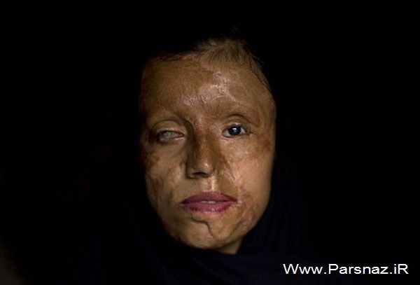 عکس های غم انگیز از زنان قربانی اسید پاشی (18+)