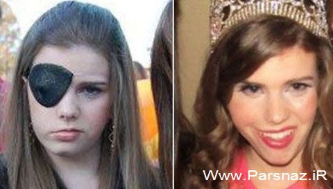 پیوند عضو متفاوت به یک دختر جوان (عکس)