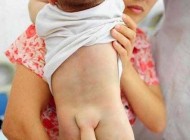 پسر بچه ای که با یک دم به دنیا آمد (عکس)
