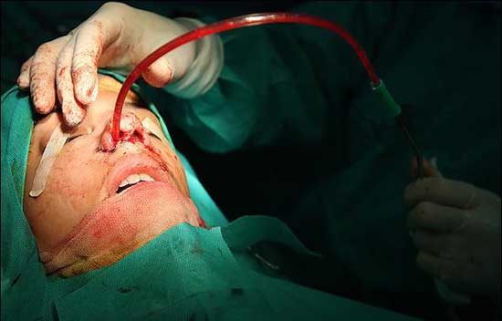 تصاویر وحشتناک از جراحی بینی 