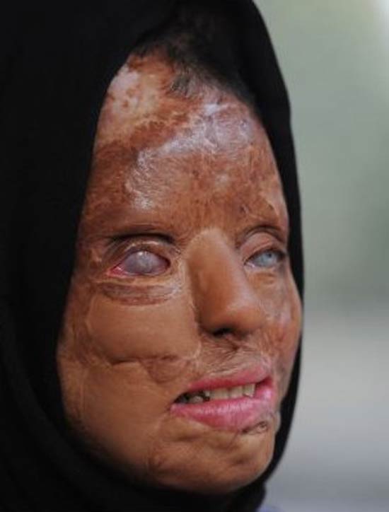 عکس های 18+ از دختر قربانی اسید پاشی انتقامی