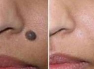داشتن خال در سن 30 سالگی را جدی بگیرید!