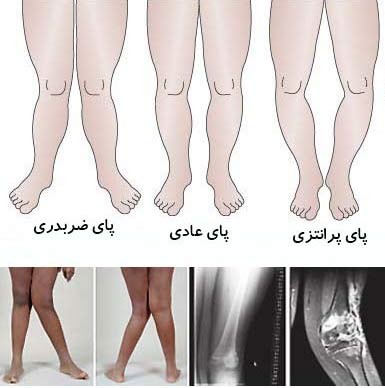 درمان پاهای ضربدری و پرانتزی!