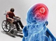درمورد نشانه های بیماری ام اس