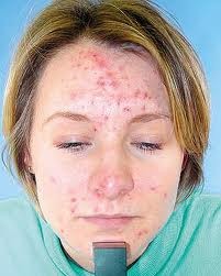 جوش و آکنه از کجا می آید؟