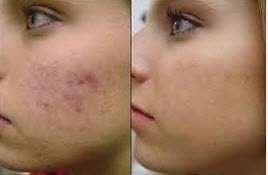 موفق ترین روش برای نابود کردن آکنه