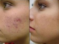 از بین بردن چاله های صورت در اثرجای جوش