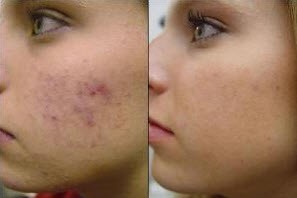 از بین بردن چاله های صورت در اثرجای جوش