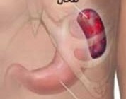عوارض برداشتن طحال
