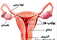 دانستنی درباره پولیپ‌ رحم