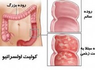 کولیت اولسراتیو  یک بیماری التهابی روده است