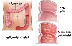 کولیت اولسراتیو  یک بیماری التهابی روده است