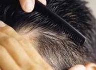 از آن دسته هستید که ریزش مو دارید؟