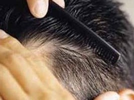 از آن دسته هستید که ریزش مو دارید؟