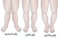 آیا پاهای پرانتزی و ضربدری قابل درمان هستند؟