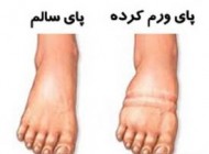 ورم پاها در اثر انسداد سیاهرگ‌ها