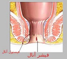 چرا دچار شقاق مقعد می شویم