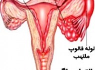 درمان خانگی و پیشگیری التهاب لگن در زنان