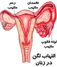 درمان خانگی و پیشگیری التهاب لگن در زنان