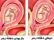 چرا دهانه رحم را میبندند؟