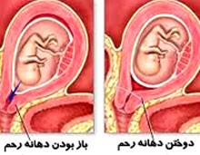 چرا دهانه رحم را میبندند؟