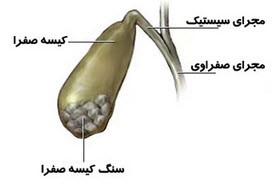 کسانی که سنگ كیسه‌ صفرا دارند چکار کنند؟