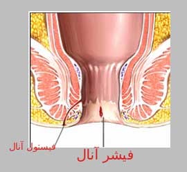 چندین راه درمان فیشر