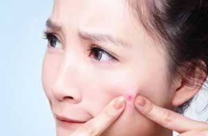 راه چاره برای جوش های مهمانی