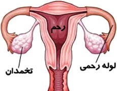 علائم چسبندگی لوله‌ های رحمی